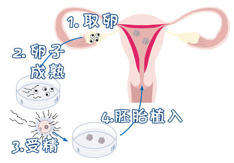 女人代怀试管